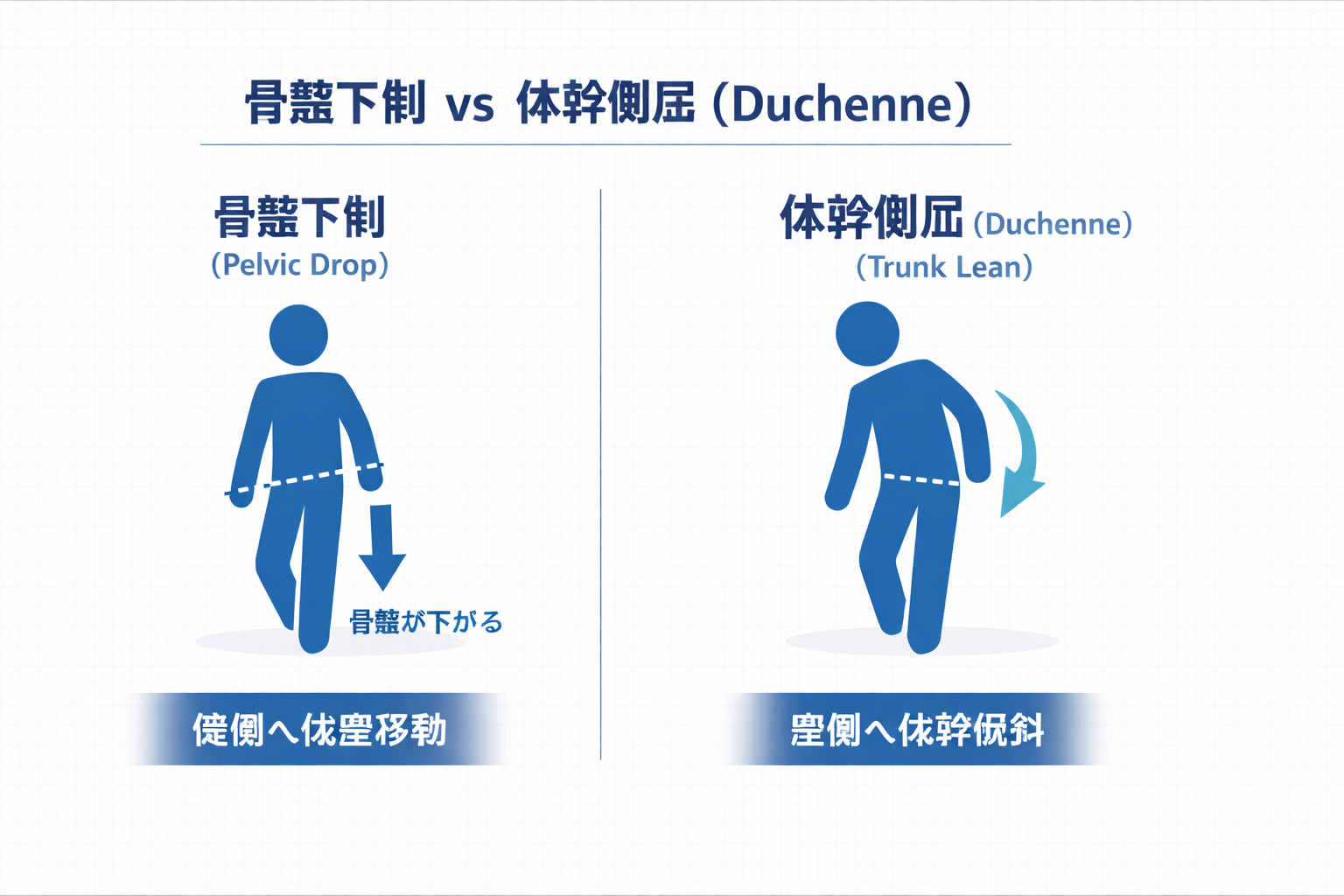 Trendelenburg（骨盤下制）歩行：出力／疼痛／支持戦略で候補を絞り、最小検証へつなぐ図
