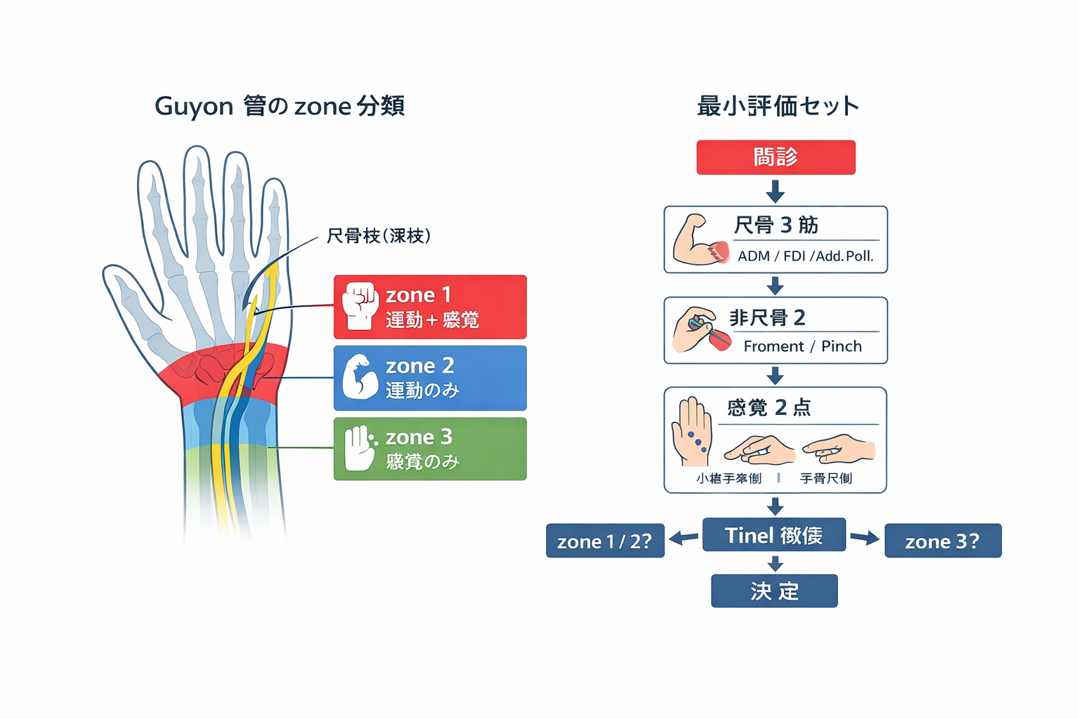 Guyon 管症候群：zone（1/2/3）と最小評価セットの図解