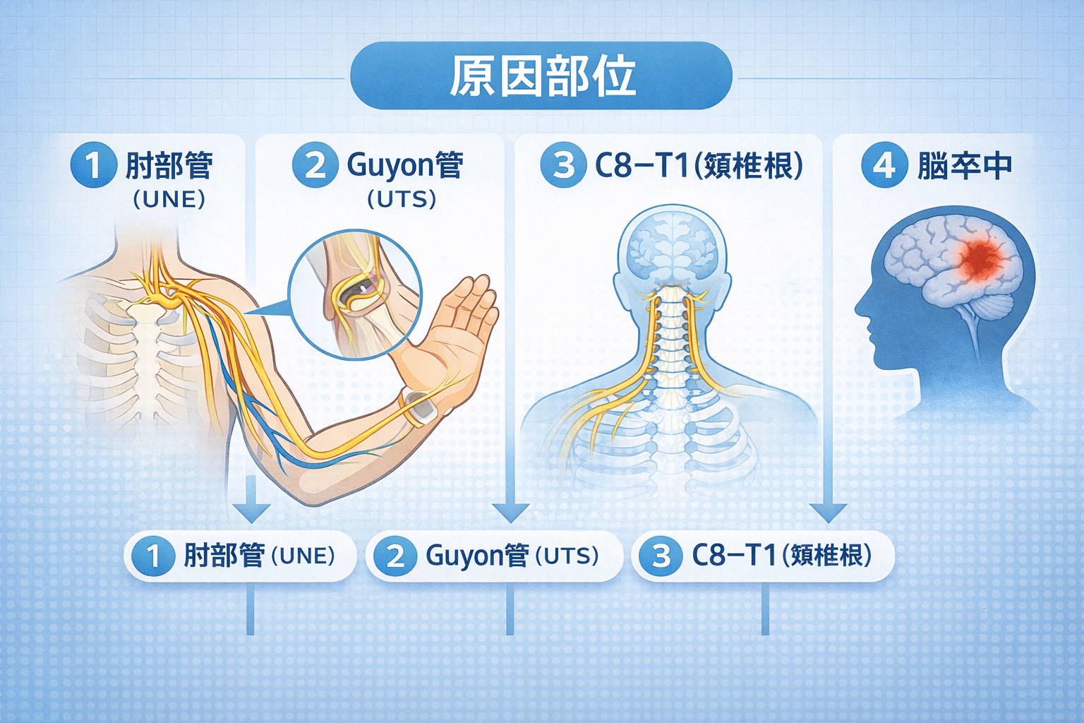 鷲手（尺骨神経麻痺）を最小セットで鑑別する図（筋力 5 点＋感覚 2 点＋ UMN ）