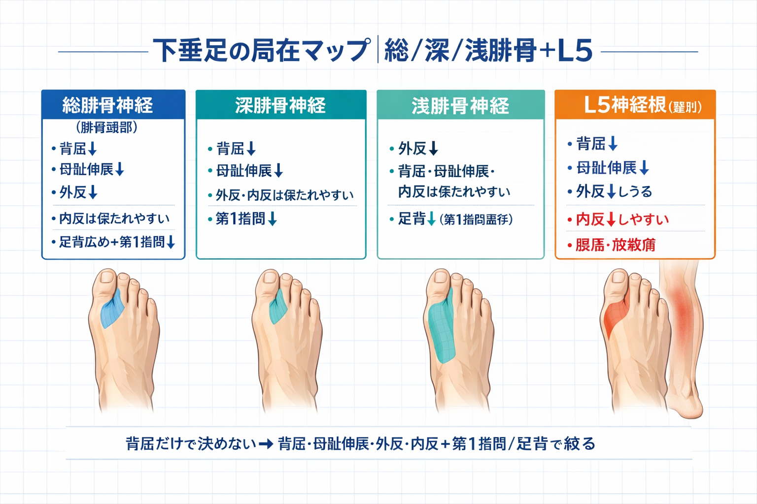 下垂足の局在マップ。総腓骨神経、深腓骨神経、浅腓骨神経、L5 神経根を筋力 4 点と感覚 2 点で比較する図。