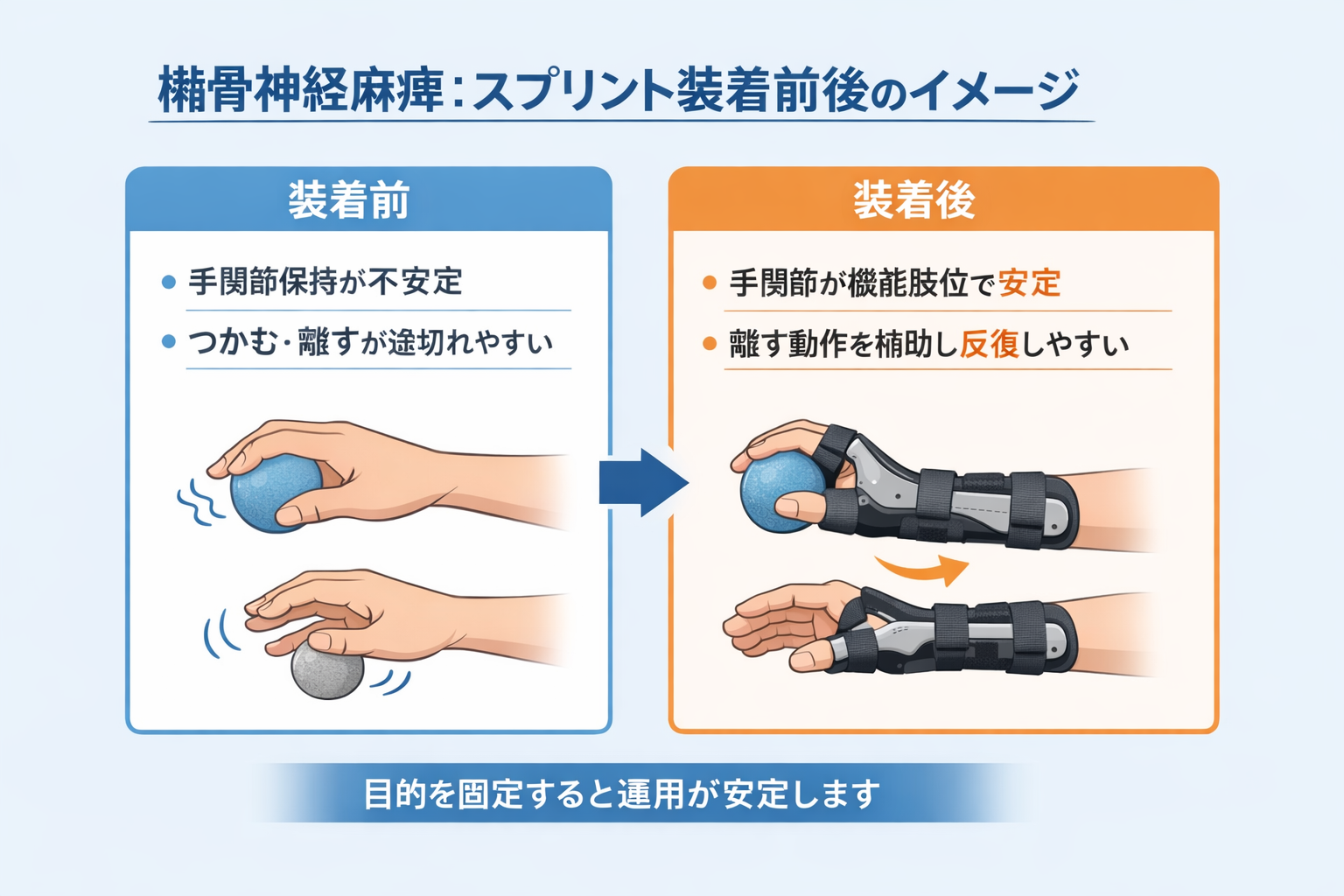 橈骨神経麻痺のスプリント装着前後の比較