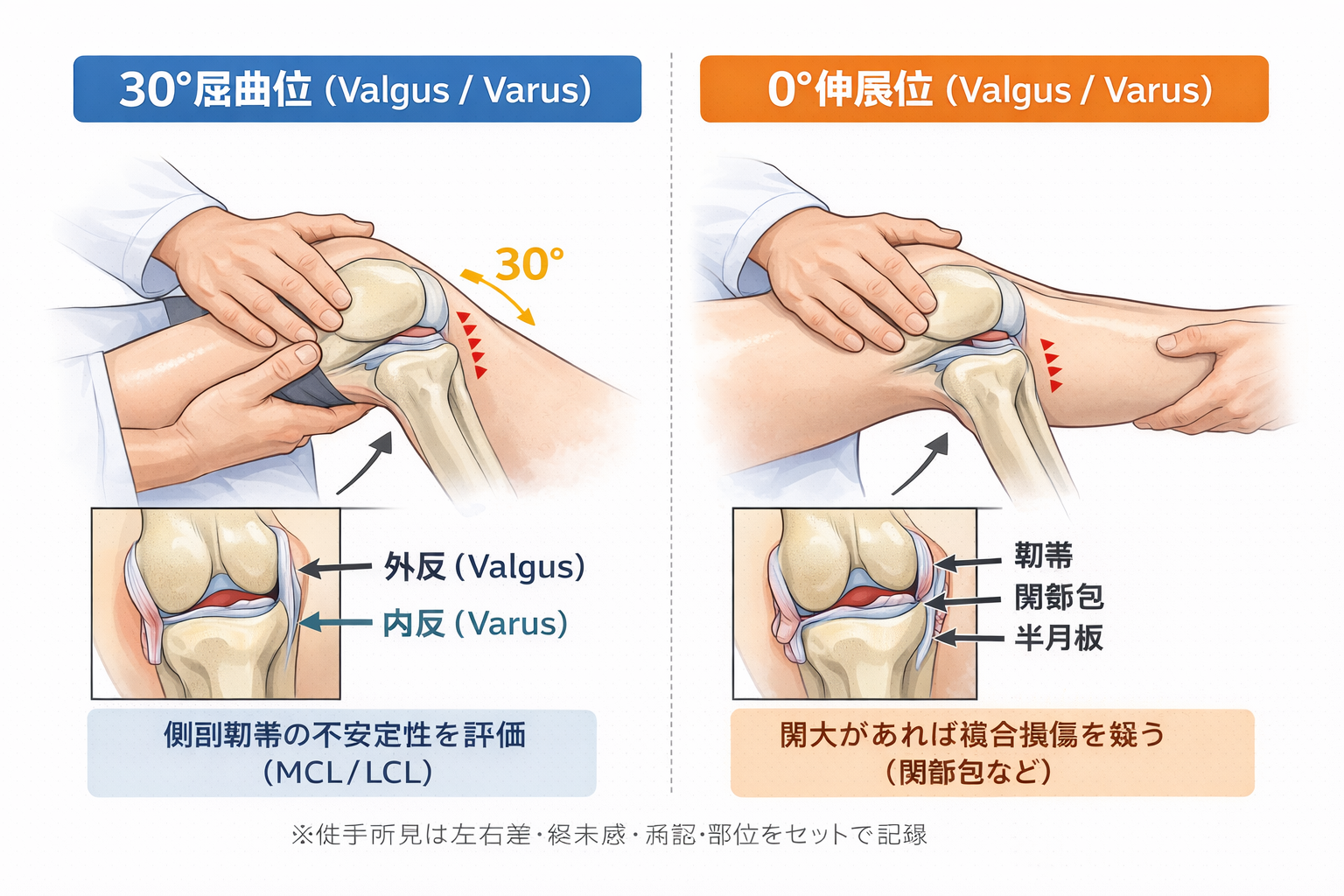 外反・内反ストレステストにおける30&deg;屈曲位と0&deg;伸展位の比較図解