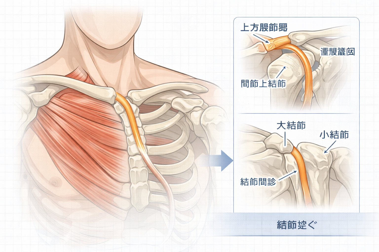 上腕二頭筋長頭腱の触診手順 3 ステップを示した図版