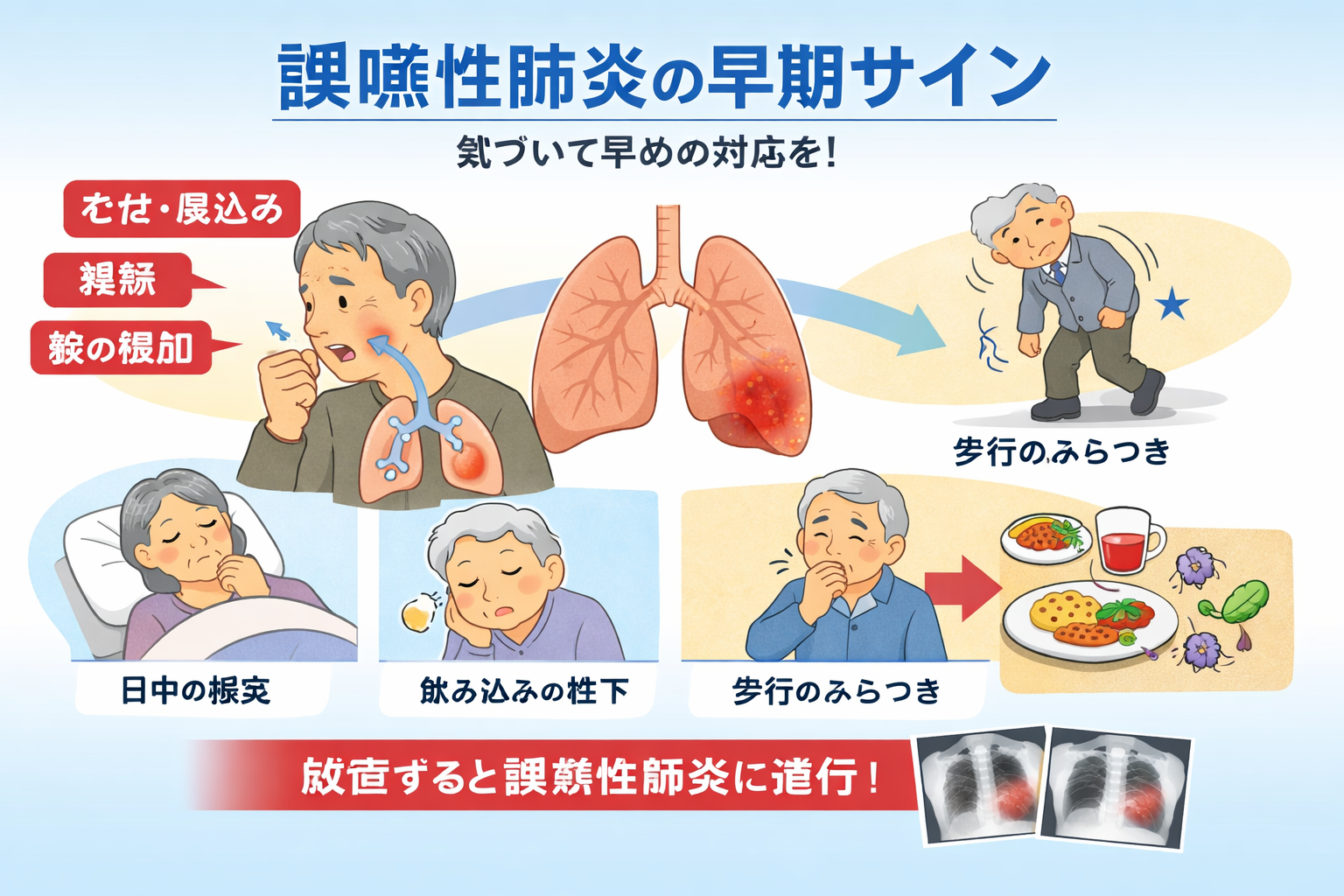 誤嚥性肺炎の予兆サインを 4 つに整理した図版