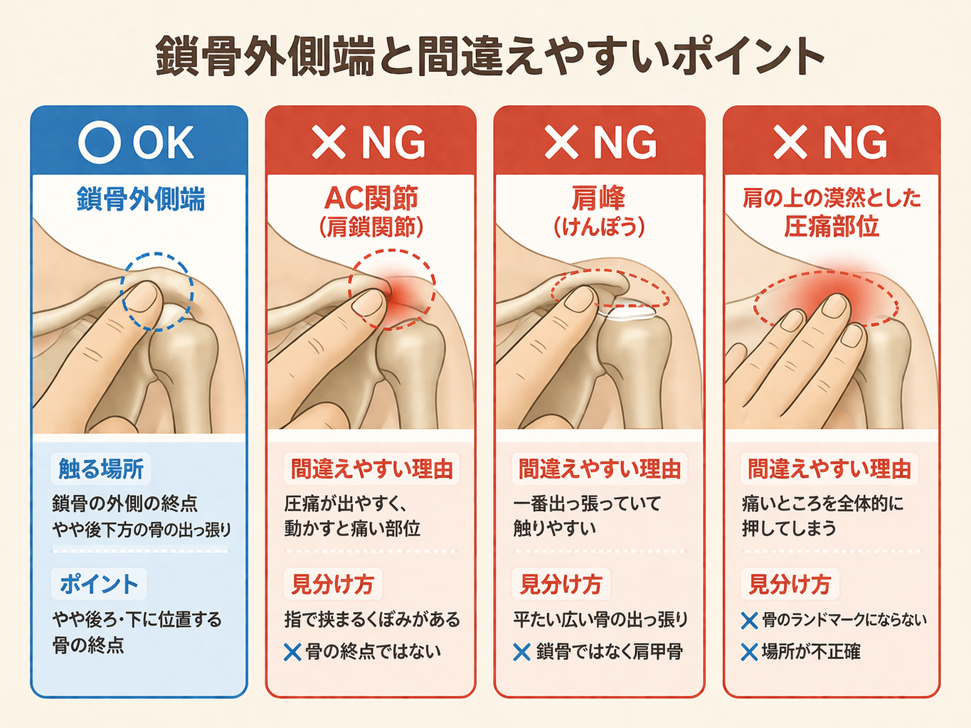 鎖骨外側端の触診手順 3 ステップを示した図版
