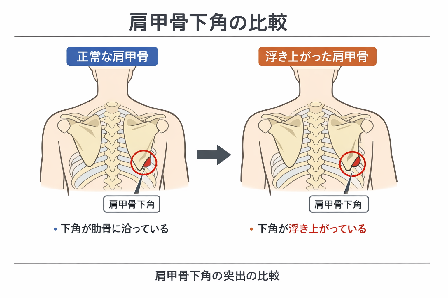 肩甲骨下角の触診手順 3 ステップを示した図版