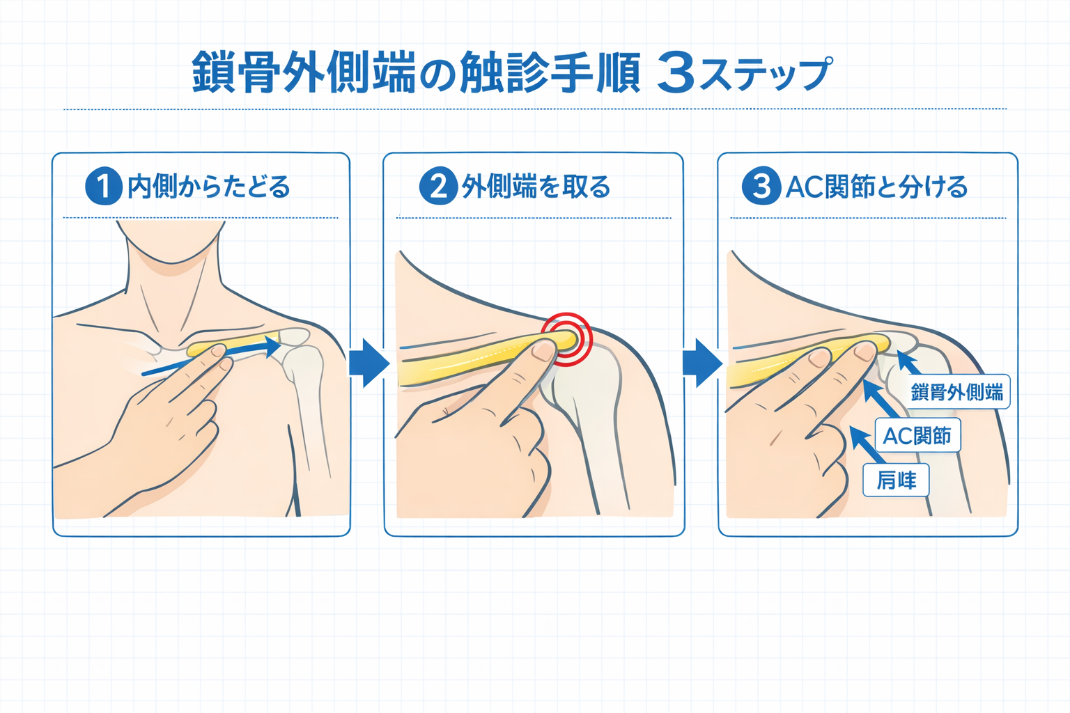 鎖骨外側端と間違えやすい部位を比較した図版