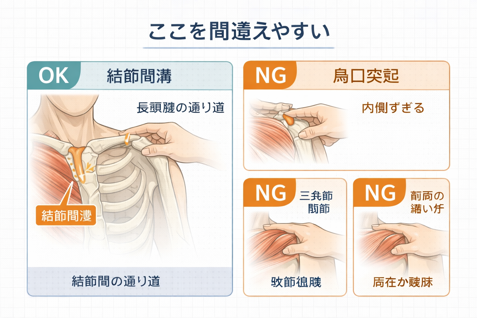 結節間溝の位置と周辺解剖を示した図版