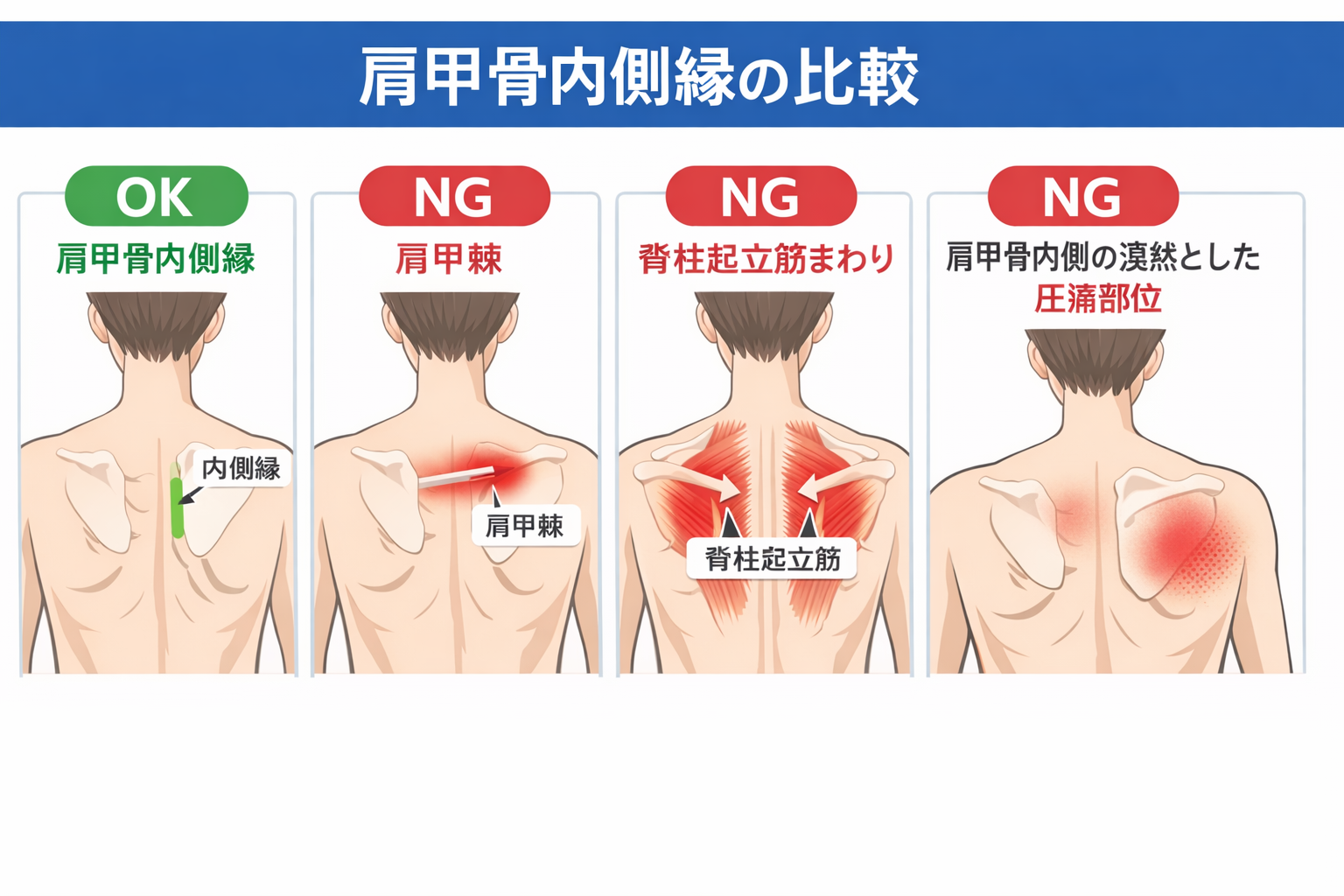 肩甲骨内側縁と間違えやすい部位を比較した図版
