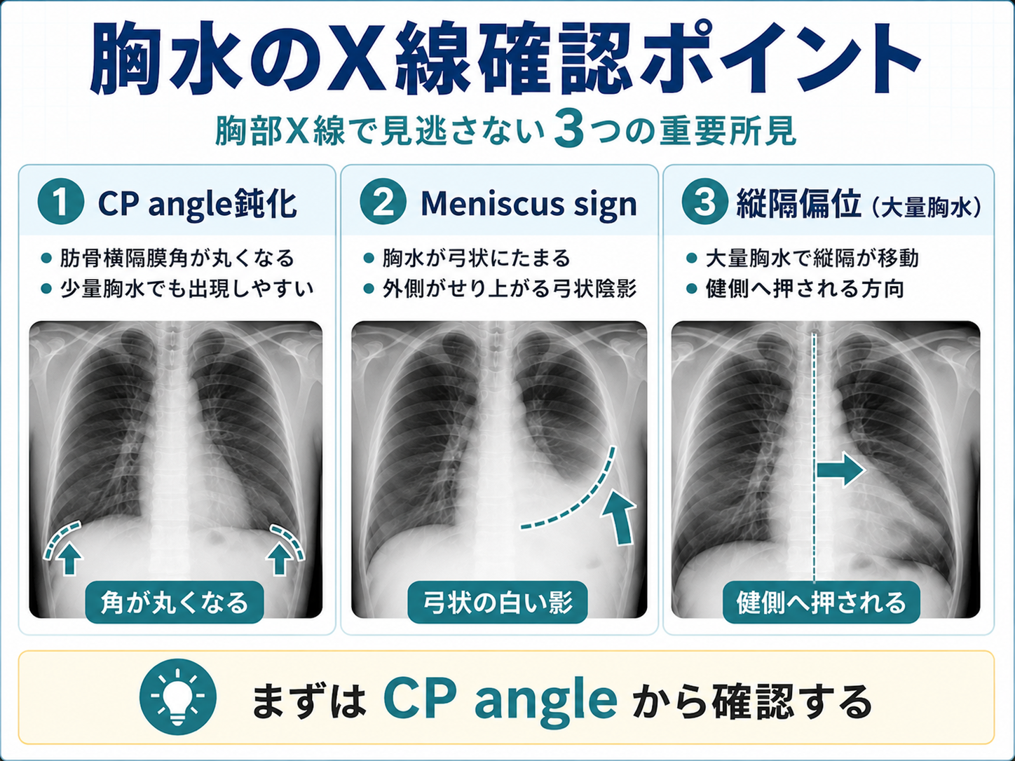 胸水のX線確認ポイントを整理した図。CP angle鈍化、Meniscus sign、縦隔偏位を示し、まずCP angleから確認することを示している。