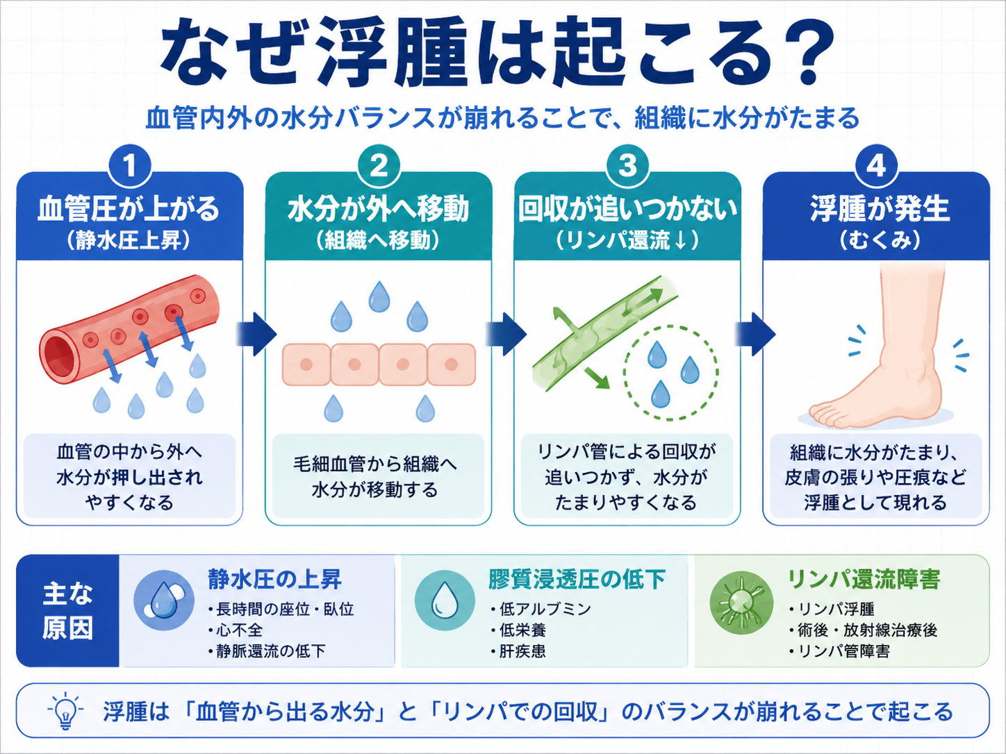 浮腫が起こる仕組みを血管圧上昇、水分移動、リンパ回収低下、浮腫発生の流れで整理した図版