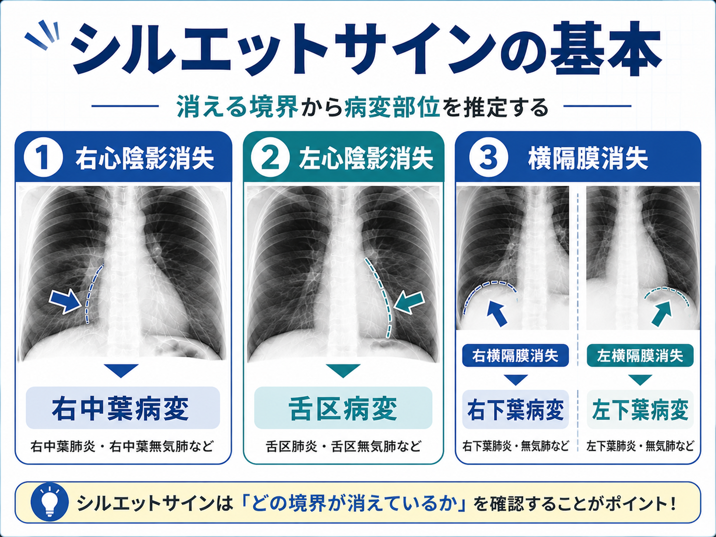 シルエットサインの基本を整理した図。右心陰影消失は右中葉病変、左心陰影消失は舌区病変、横隔膜消失は下葉病変を示している。