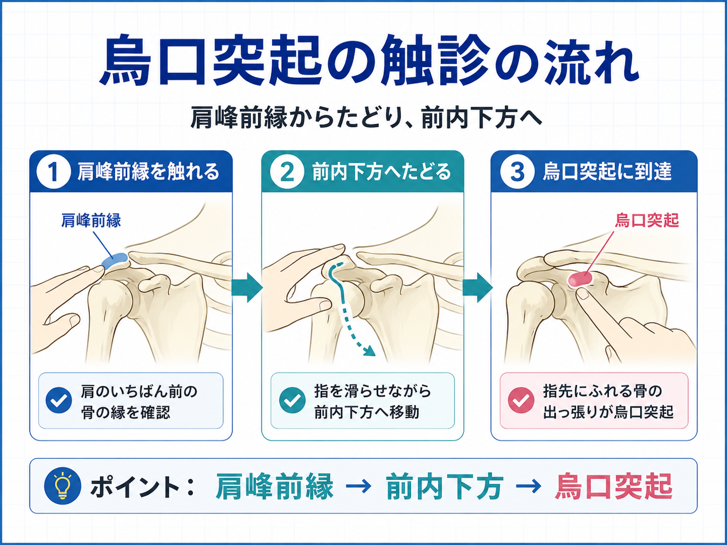 烏口突起の触診手順を示した図版。肩峰前縁から前内下方へたどり烏口突起を触知する流れを示す。