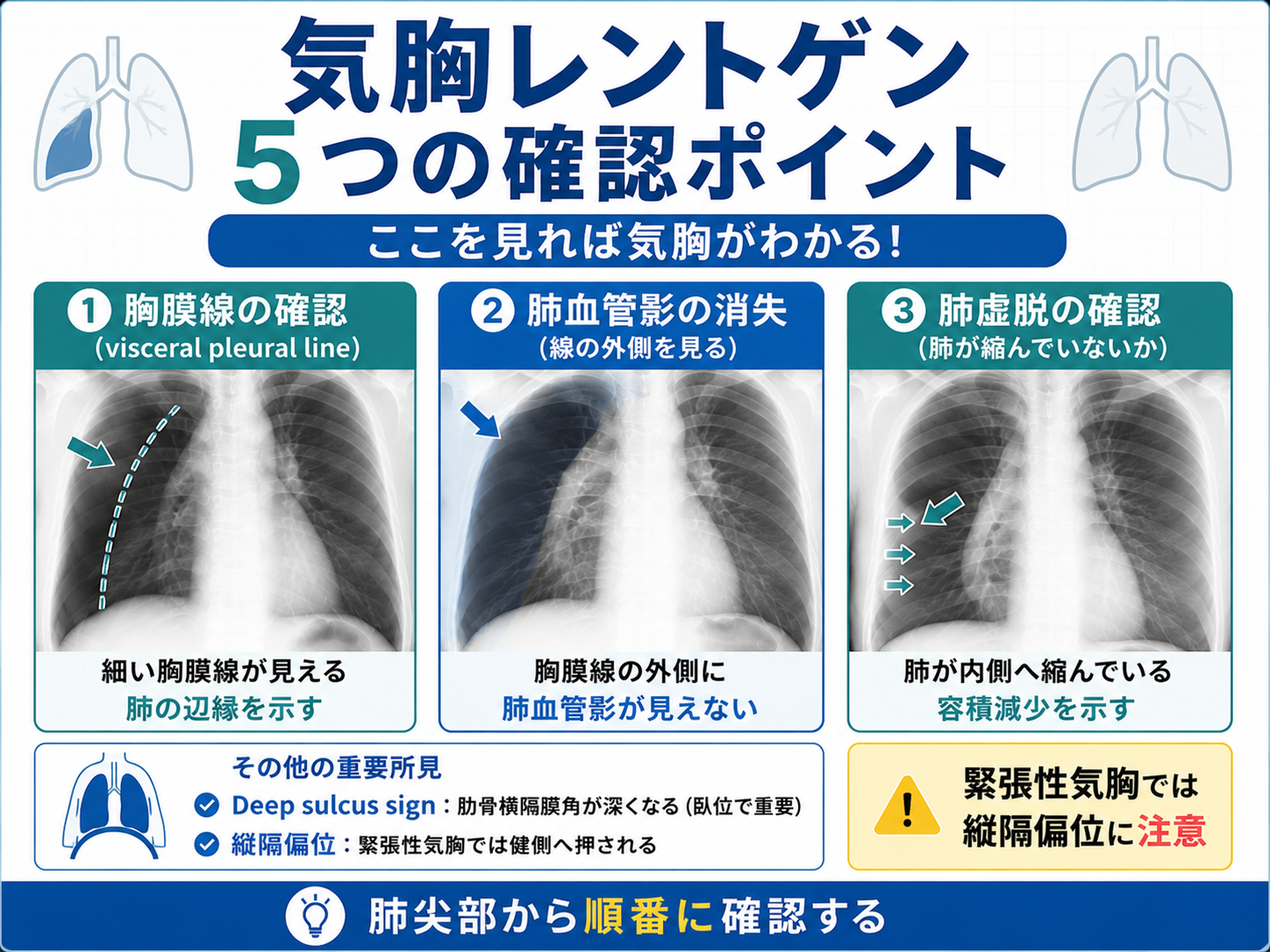 気胸レントゲンの確認ポイントを整理した図。胸膜線の確認、肺血管影の消失、肺虚脱、deep sulcus sign、縦隔偏位を示している。