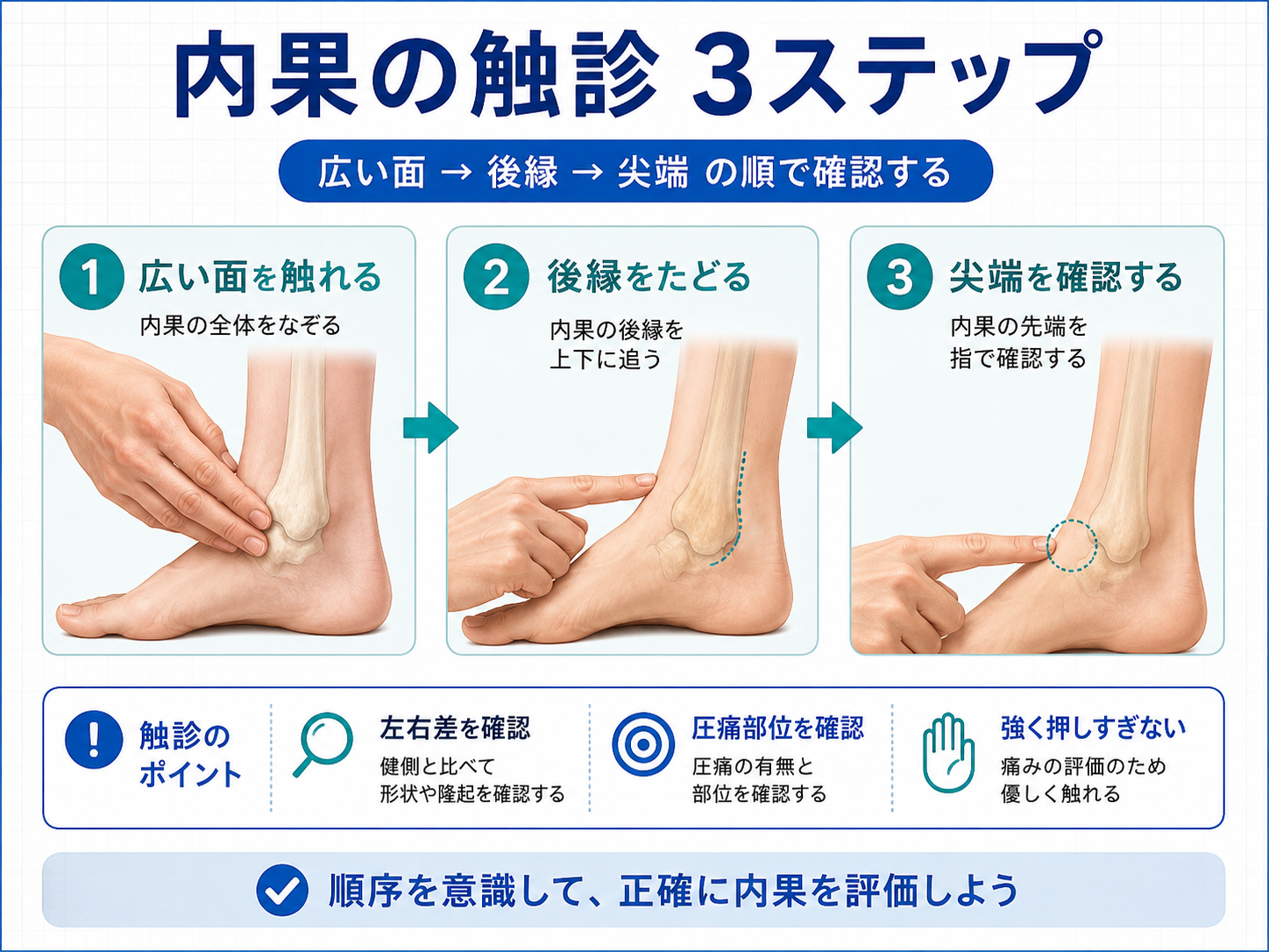 内果の触診を広い面、後縁、尖端の3ステップで示した図版