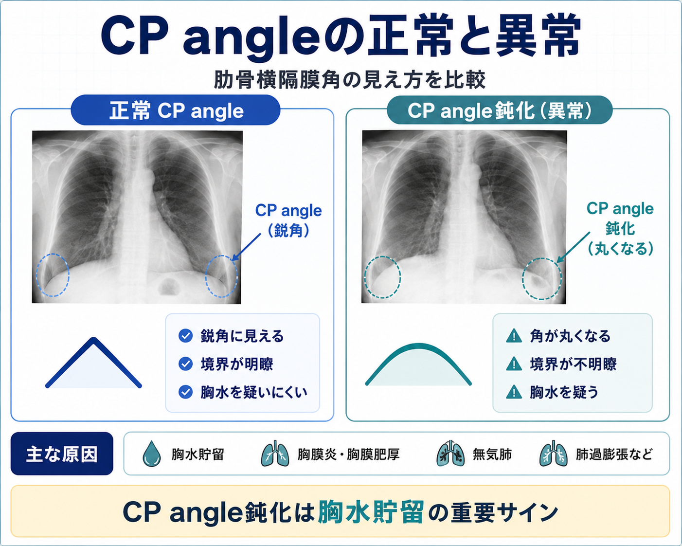 CP angleの正常所見と鈍化所見を比較した図。正常では鋭角で境界明瞭に見え、鈍化では角が丸くなり胸水貯留を疑うことを示している。