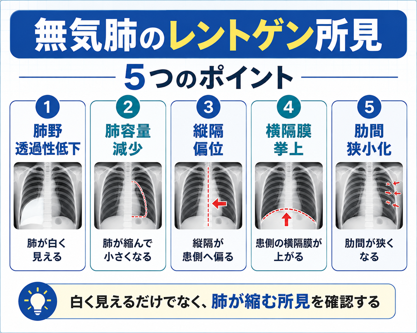無気肺のレントゲン所見5つを整理した図。肺野透過性低下、肺容量減少、縦隔偏位、横隔膜挙上、肋間狭小化を示している。