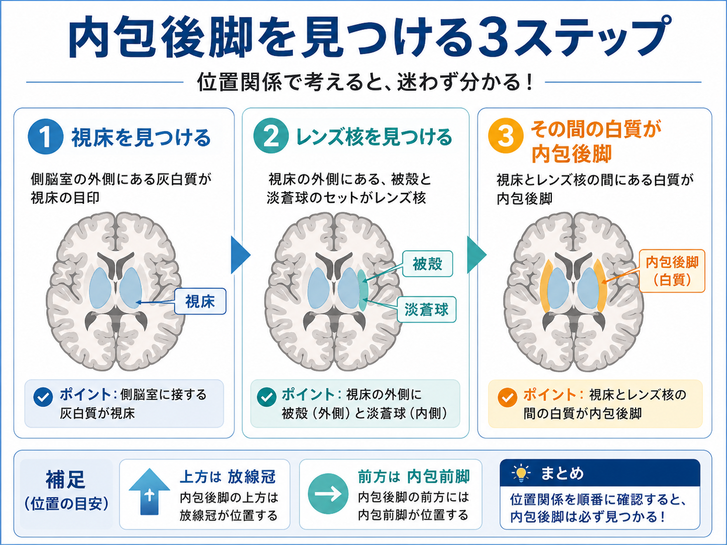 内包後脚を見つける3ステップ。視床、被殻と淡蒼球からなるレンズ核、両者の間にある白質を順番に確認する