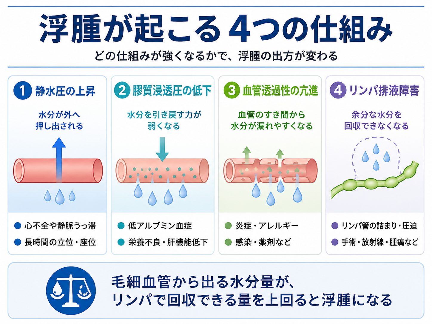浮腫が起こる4つの仕組みを静水圧の上昇、膠質浸透圧の低下、血管透過性の亢進、リンパ排液障害に分けて整理した図版