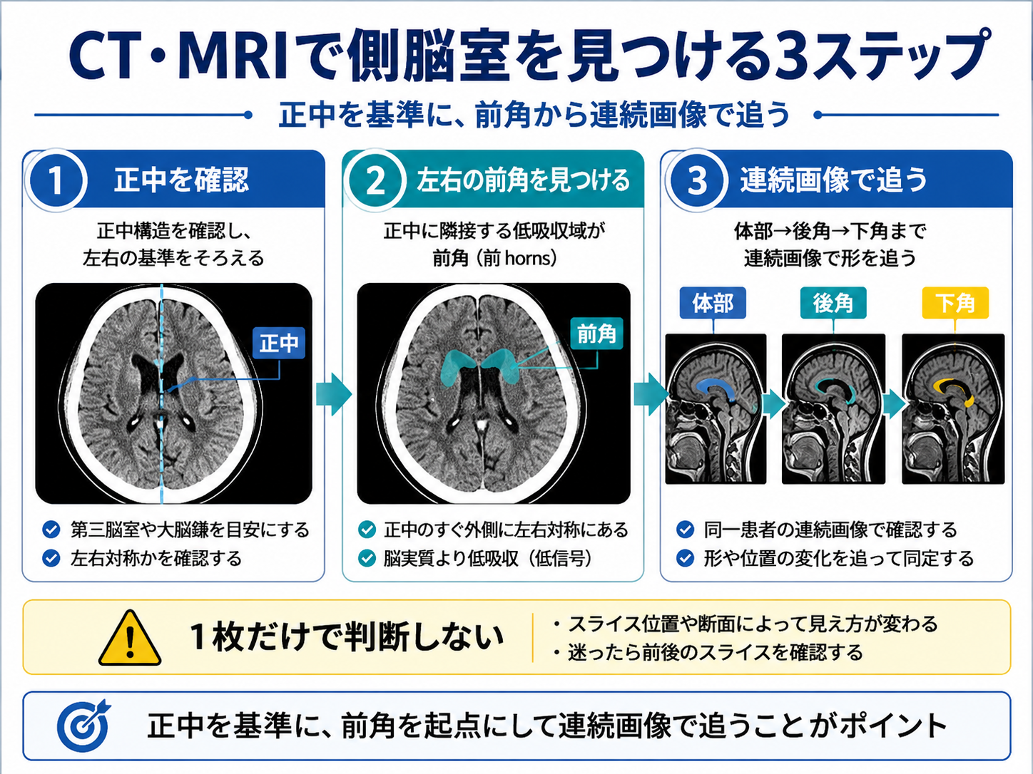 CT・MRIで側脳室を見つける3ステップ。正中を確認し、左右の前角を見つけ、連続画像で体部・後角・下角を追う流れを示している。