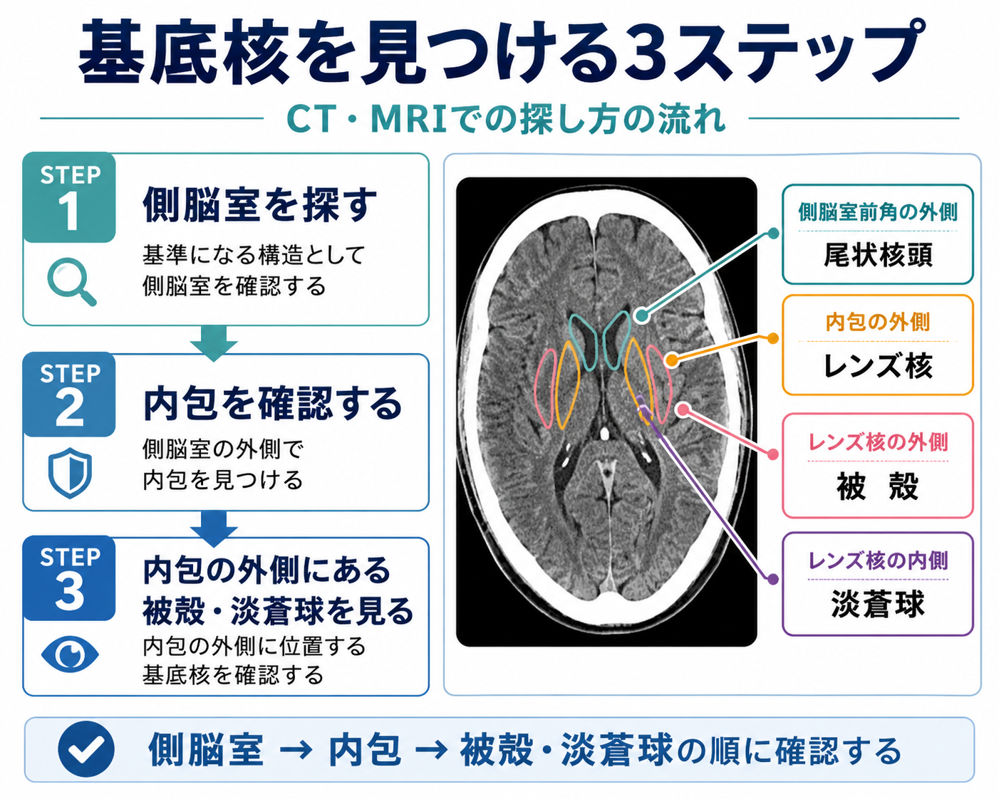 CT・MRIで基底核を見つける3ステップ。側脳室、内包、被殻・淡蒼球の順に位置を確認する方法を示している。
