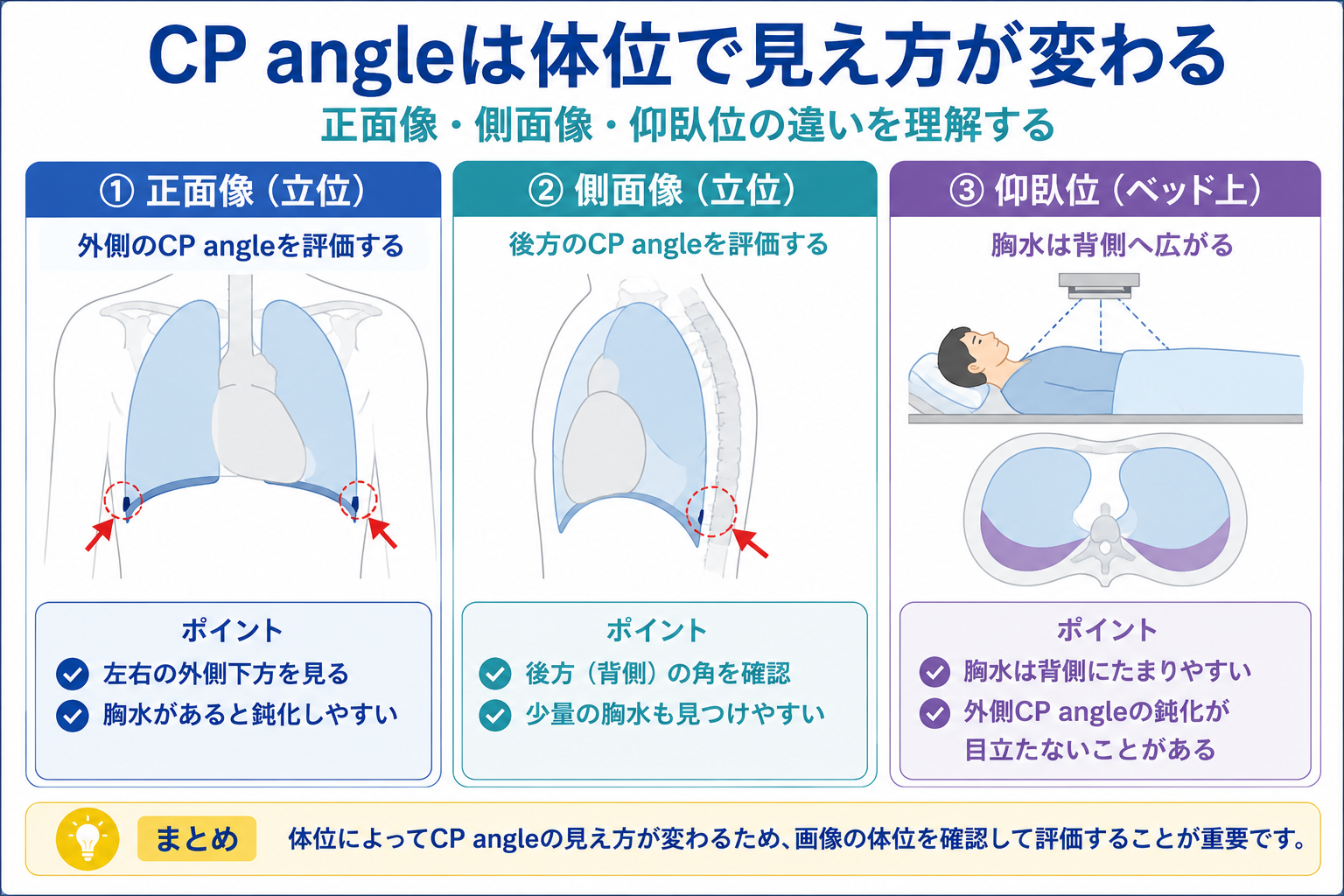 CP angleの見え方を撮影体位別に示した模式図。立位正面像では外側、立位側面像では後方のCP angleを確認し、仰臥位では胸水が背側へ広がって外側の鈍化が目立たないことがある。