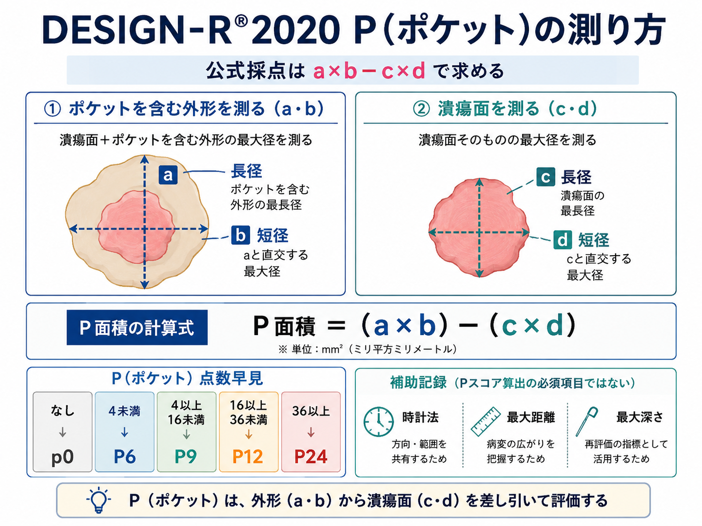 DESIGN-R 2020のP(ポケット)について、ポケットを含む外形のa・bと潰瘍面のc・d、計算式、P点数、補助記録を整理した図