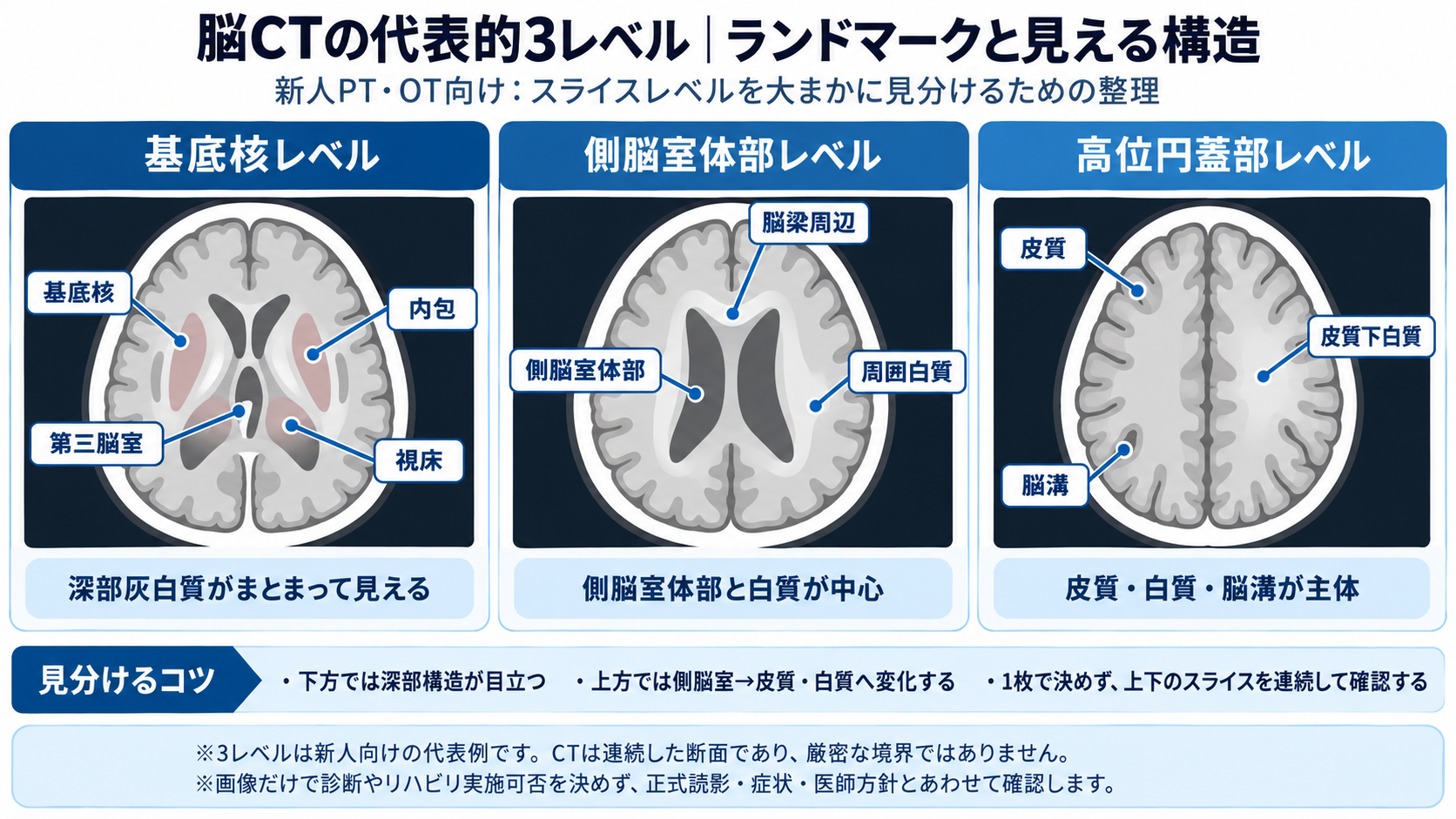 脳CTの代表的3レベルとして基底核レベル、側脳室体部レベル、高位円蓋部レベルのランドマークを示した模式図