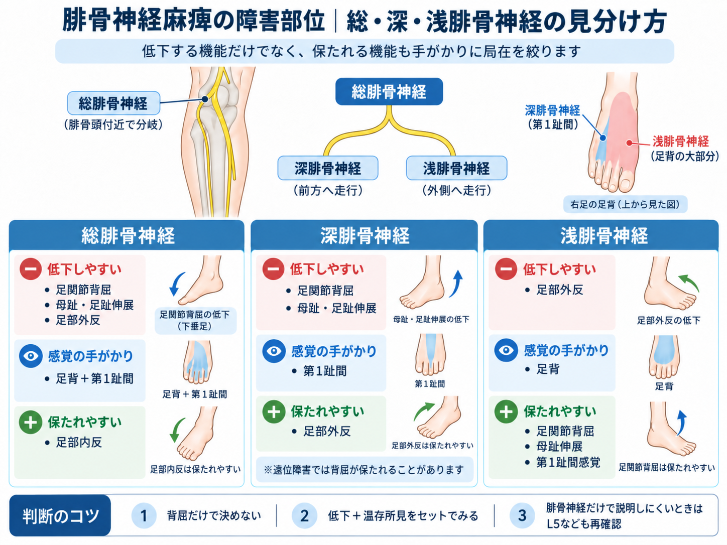 腓骨神経麻痺の障害部位。総腓骨神経・深腓骨神経・浅腓骨神経の見分け方を、低下しやすい機能、感覚の手がかり、保たれやすい機能で比較した図版。