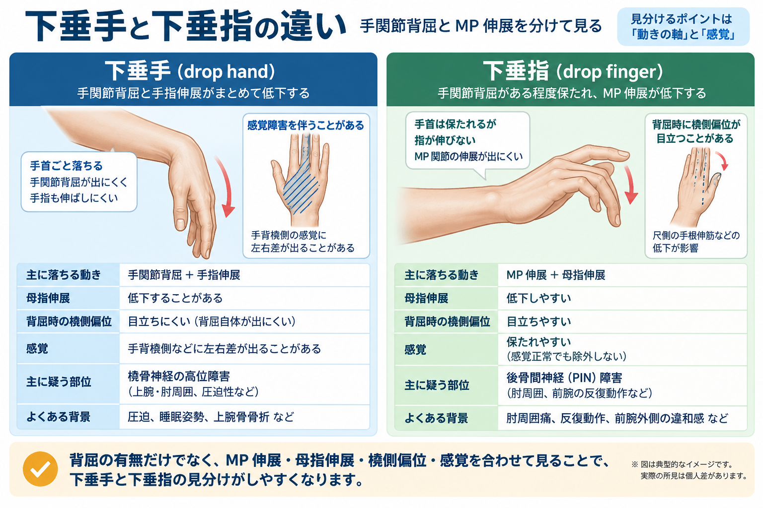 下垂手と下垂指の違い。手関節背屈、MP関節伸展、母指伸展、橈側偏位、感覚の違いを比較した図