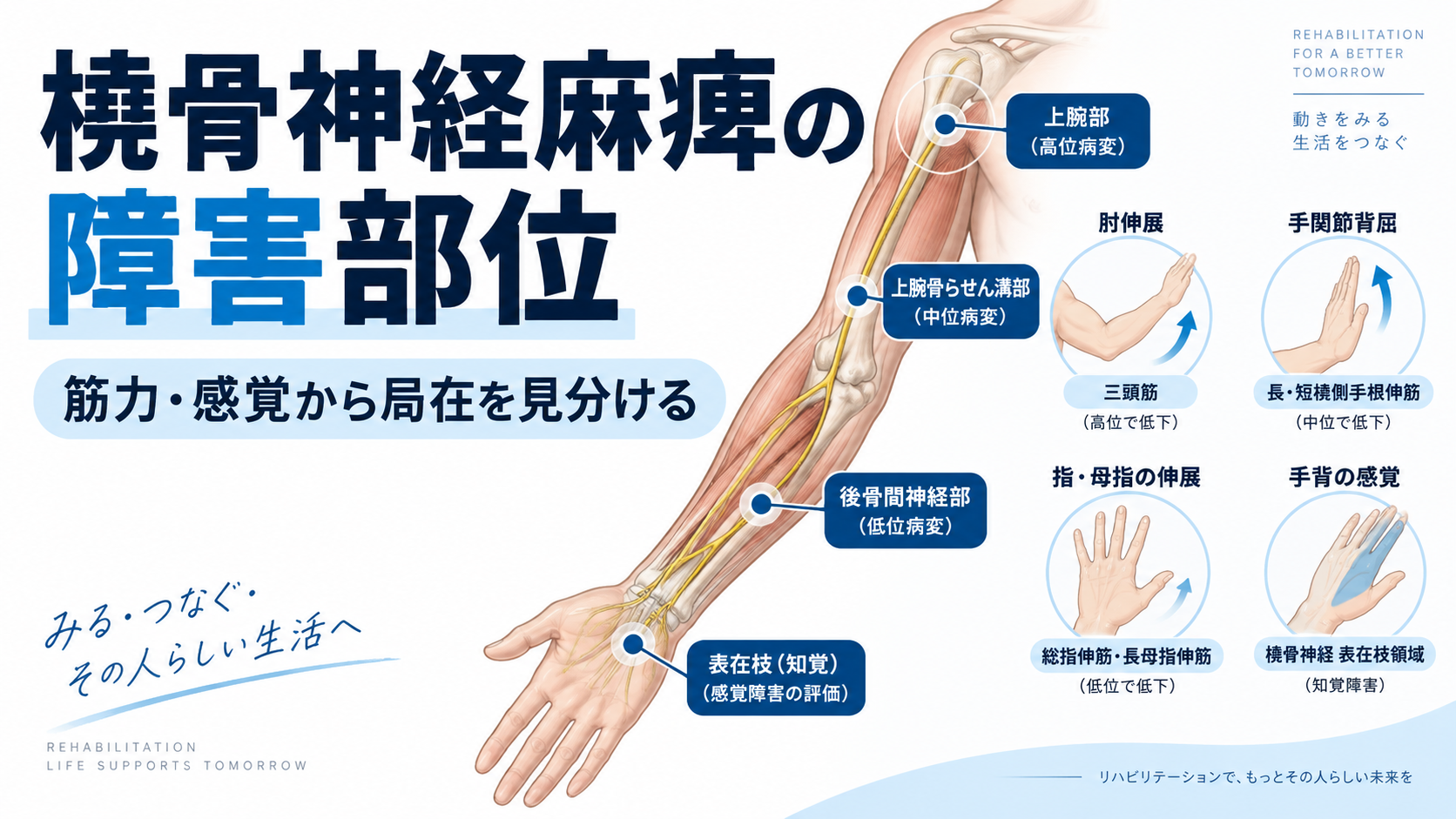 橈骨神経麻痺の障害部位｜筋力・感覚から局在を見分ける | rehabilikun