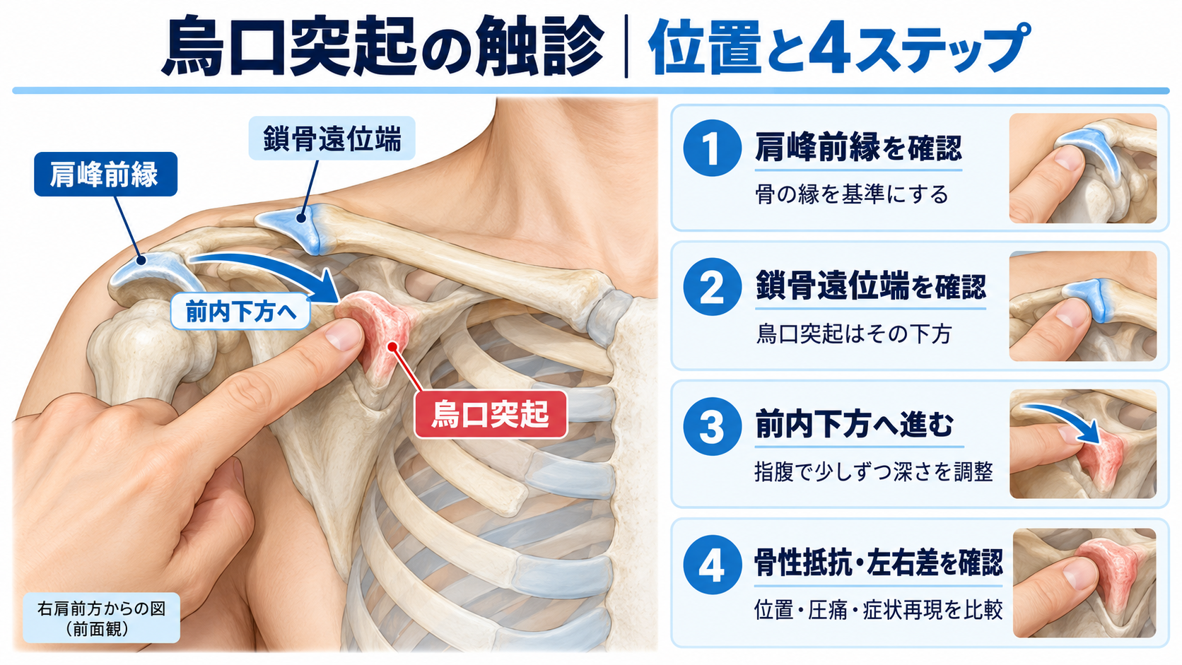 烏口突起の触診方法を示した図版。右肩前面の肩峰前縁、鎖骨遠位端、烏口突起の位置関係と、骨性ランドマークの確認、前内下方への移動、骨性抵抗・左右差の確認までの4ステップを示す。